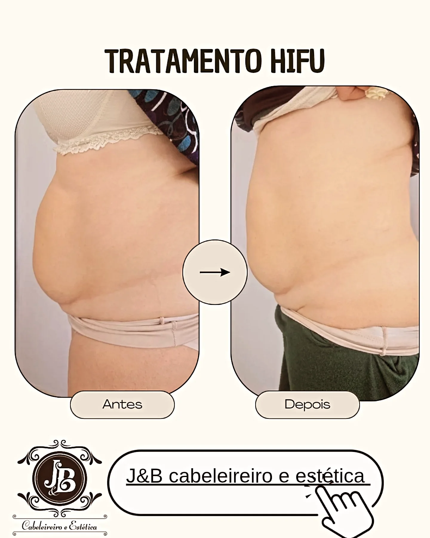 Tratamento HIFU - Resultados de tratamento corporal